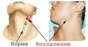 Туберкулезный лимфаденит: причины, симптомы и лечение