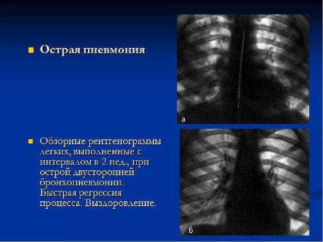 Пневмония. схема лечения у взрослого, антибиотики, народные средства, лекарства