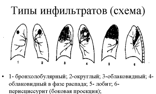 Заразна ли латентная туберкулезная инфекция или скрытая форма туберкулеза