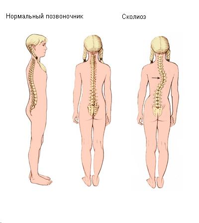 Сколиоз у детей - симптомы, лечение и причины болезни