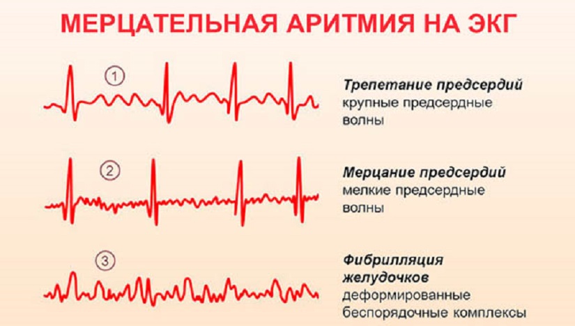 Лечебная диета при аритмии сердца: полезные продукты и противопоказания по возрасту
