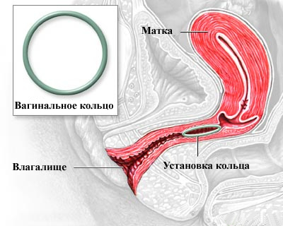 Кольцо новаринг - отзывы