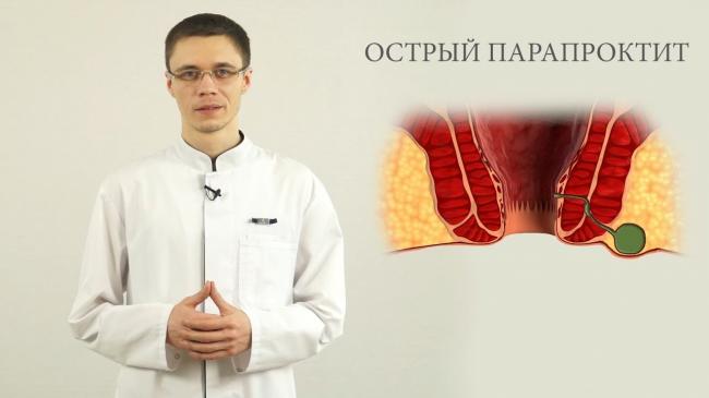 Абсцессы прямой кишки симптомы и лечение - острый парапроктит