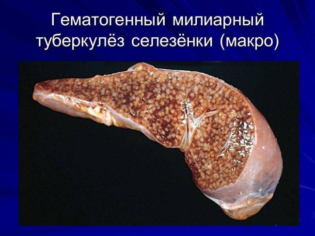 Туберкулез органов дыхания с широкой лекарственной устойчивостью у взрослых