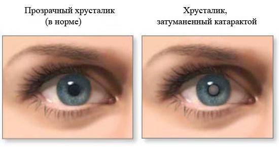После замены хрусталика глаз видит мутно - причины и что делать