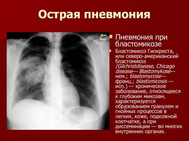 Правосторонняя пневмония