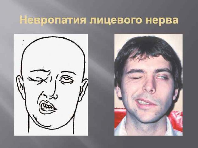 Паралич лицевого нерва симптомы и лечение