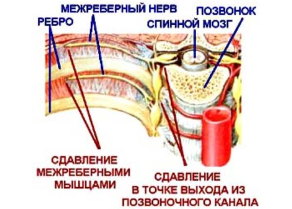 Межреберная грыжа симптомы лечение