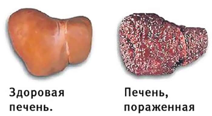 Хронический гепатит