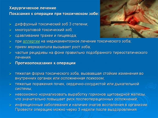 Причины появления эндемического зоба у взрослых и детей, терапия заболевания