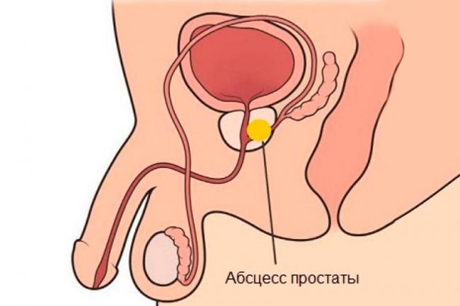 Заболевание простаты у мужчин лечение