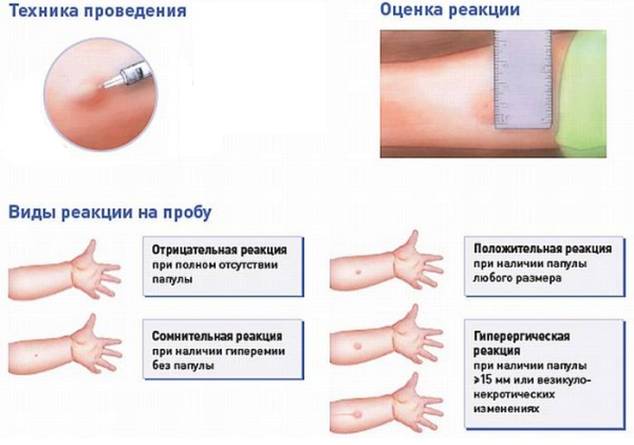Реакция манту положительная: причины, объяснения, фото