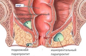 Абсцессы прямой кишки симптомы и лечение - острый парапроктит