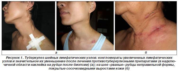 Туберкулез лимфоузлов — симптомы, первые признаки