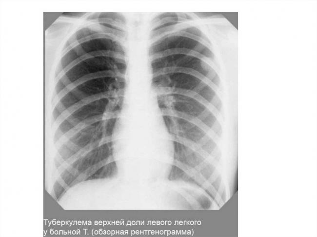 Очаговый туберкулез легких: особенности и лечение