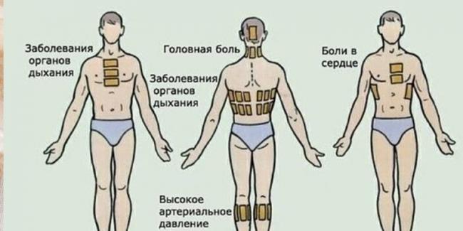 Можно ли ставить горчичники при бронхите и воспалении легких