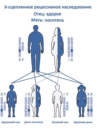 Дисгенезия гонад (синдром шерешевского - тернера)