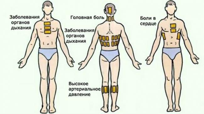 Могут ли назначаться горчичники при астме