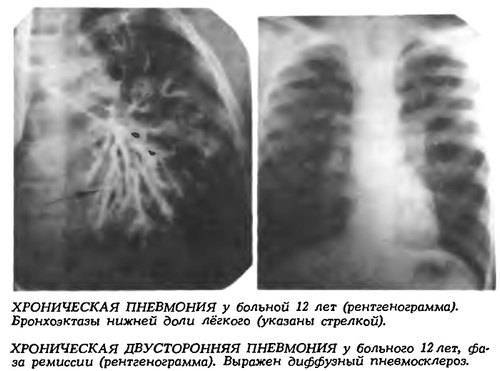 Острая пневмония