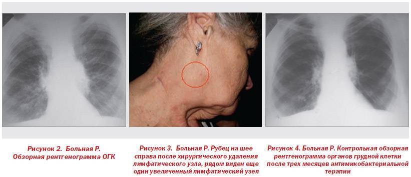 Туберкулез — симптомы и первые признаки, причины, диагностика туберкулёза