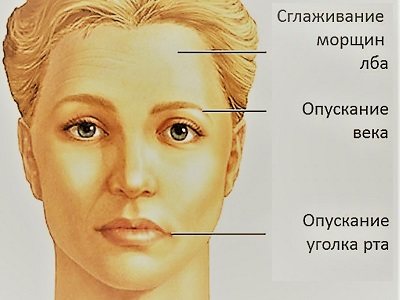 Воспаление тройничного нерва - симптомы, лечение