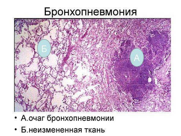 Узнайте, как отличить пневмонию от бронхита у детей