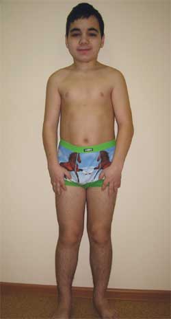 Синдром маккьюн-олбрайт - mccune–albright syndrome - qwe.wiki