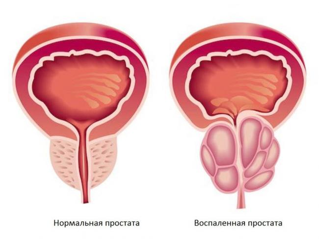 Воспаление простаты у мужчин: симптомы, причины, лечение