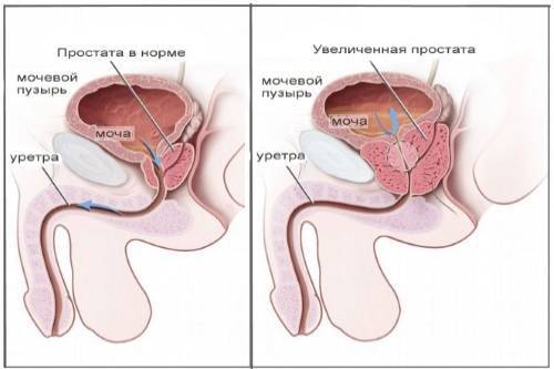 Закрытая форма туберкулеза легких: симптомы и лечение