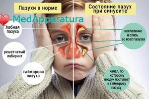 Быстрое лечение гайморита у взрослых в домашних условиях: аптечные препараты, народные средства