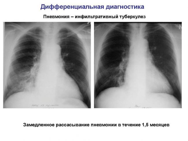Возможен ли переход пневмонии в туберкулез