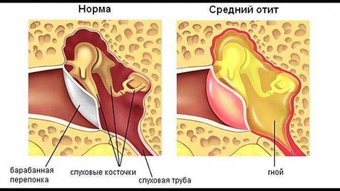 Лечение гайморита у взрослых в домашних условиях – эффективные народные средства