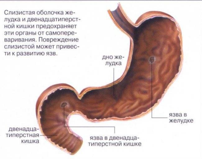 Какой вред наносят язвообразующие бактерии в желудке