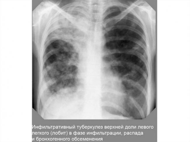 Очаговый туберкулез легких: причины, симптомы и лечение