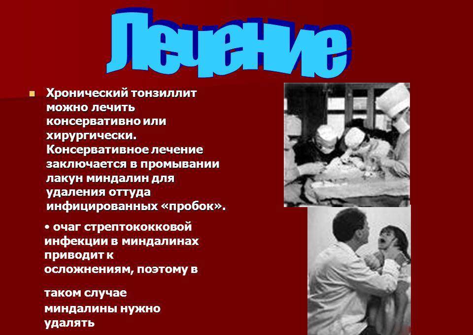 Хронический тонзиллит - на всю жизнь?