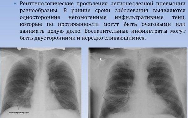 Клиническая картина стафилококковой пневмонии