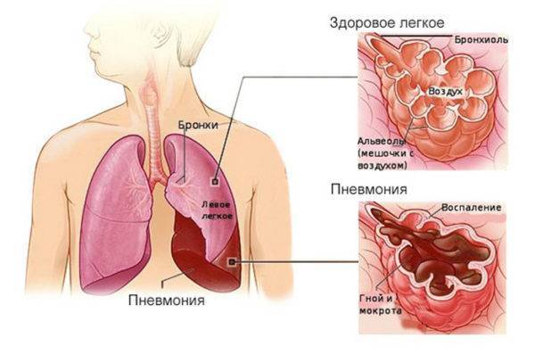 Не проходят хрипы в бронхах