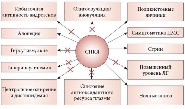 Поликистоз яичников: симптомы, диагностика, лечение