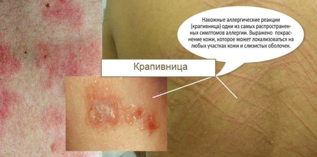 Все об аллергии на сладкое. симптомы, признаки, лечение заболевания