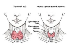 Что делать при эндемическом зобе у взрослых и детей