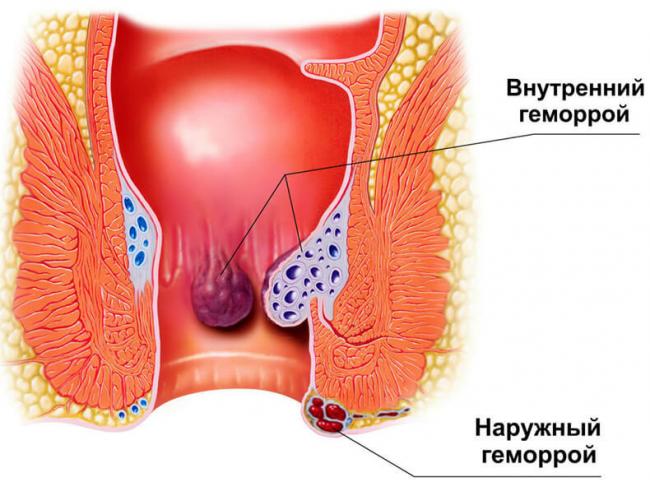 Геморрой и рак: как отличить на ранних стадиях патологии?
