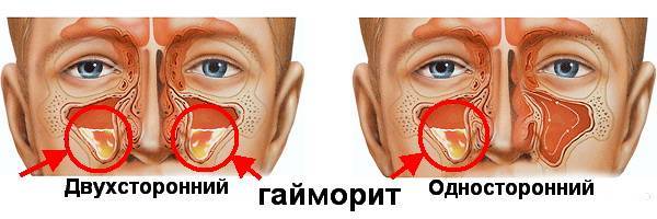 Гайморит - симптомы и лечение у взрослых. какие антибиотики и народные средства принимают при гайморите
