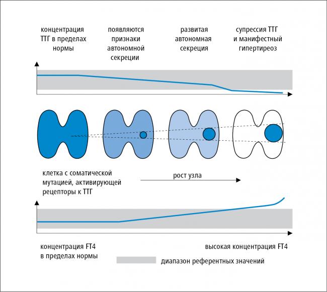Какие причины провоцируют узловой зоб щитовидной железы 2 степени, основные симптомы и методы лечения?