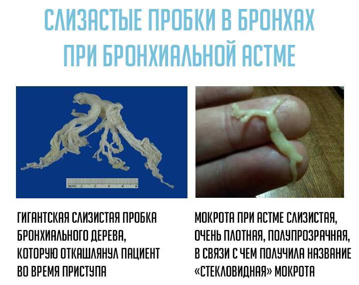 Виды мокроты при астме и способы ее выведения