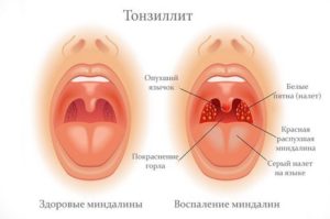 Тонзилгон капли инструкция по применению цена отзывы аналоги цена