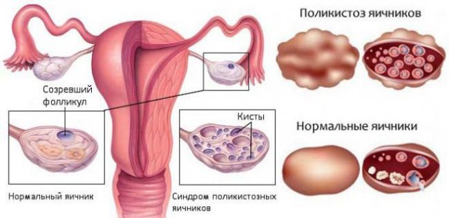 Последствия воздержания от секса для женского организма