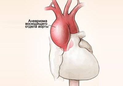 Аневризма брюшной аорты: лечение, симптомы, причины, профилактика | болезни артерий | сосудистый центр им. т.топпера