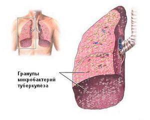 Туберкулез – первые признаки, симптомы, причины, лечение и профилактика туберкулеза