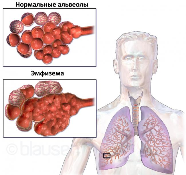 Диффузный пневмосклероз легких – что это такое, сколько живут?