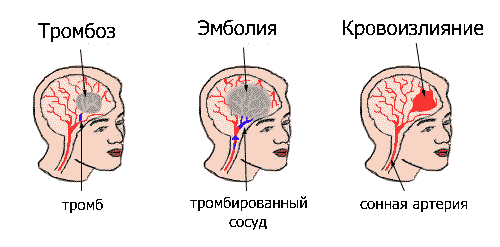 Лечение нарушений системы кровообращения человека